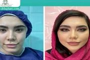 ماندگاری تزریق چربی به صورت چقدر است؟

