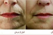 روش‌های جلوگیری از چروک لب
