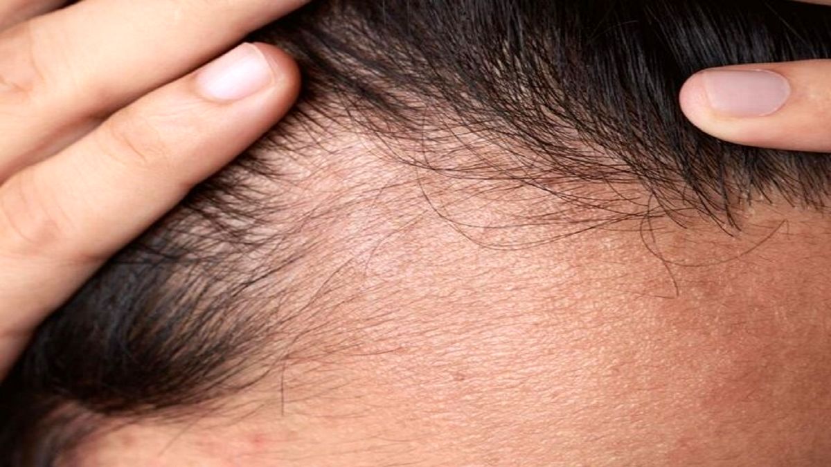 ۶ دلیل که سبب ریزش موها می‌شوند

