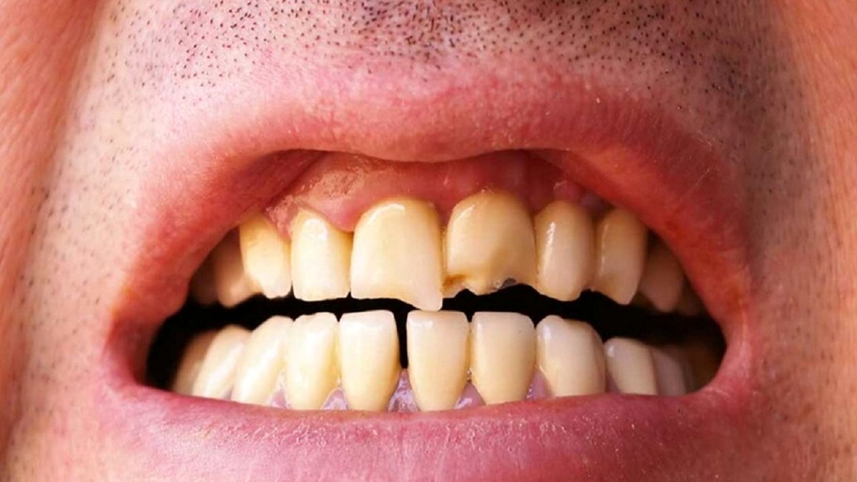 ۸ نکته برای جلوگیری از درد، تورم و خونریزی لثه
