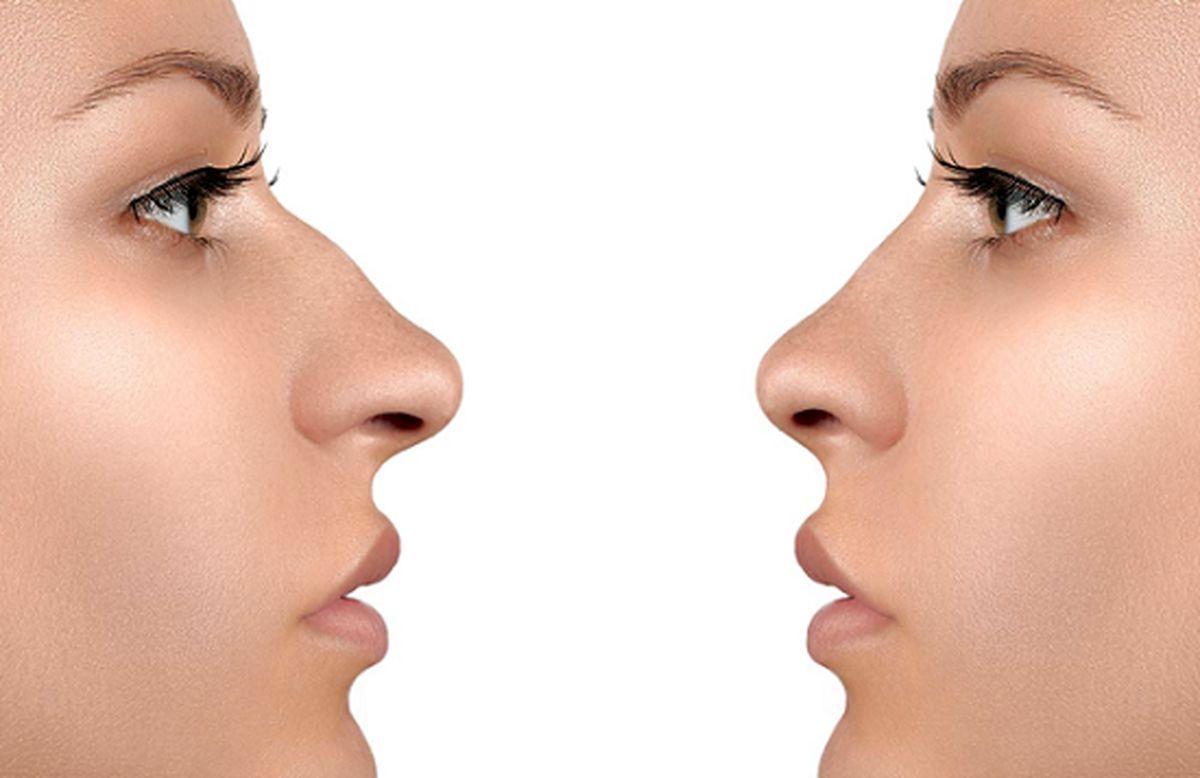 آیا به جراحی بینی فکر می کنید؟