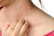 کدام غذاها برای درمان کهیر مفید هستند؟
