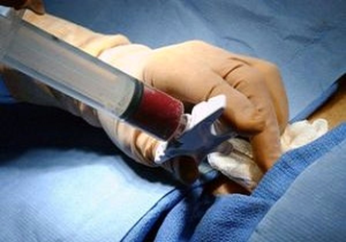استفاده از استخوان اجساد در جراحی کودکان تهرانی 