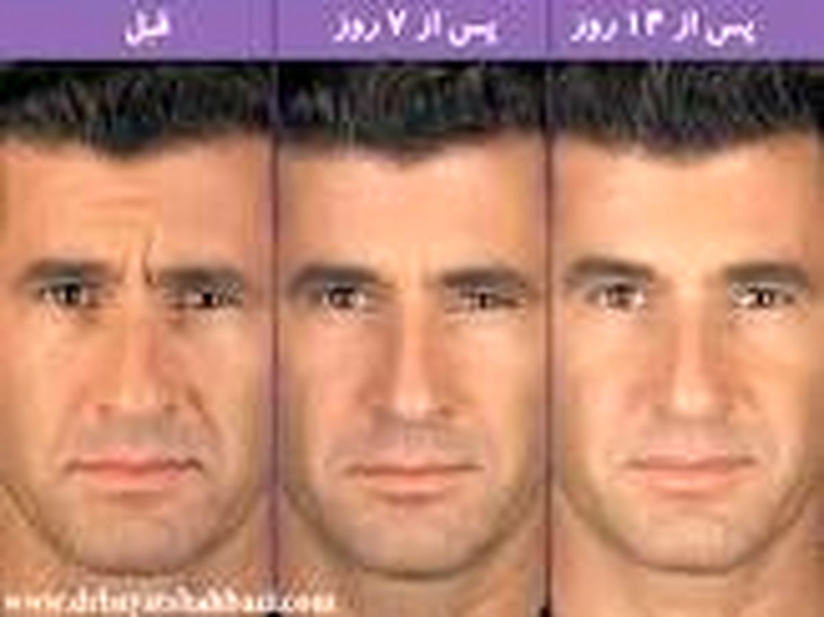 سن مناسب برای تزریق بوتاکس