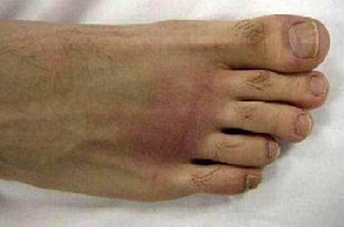 داغ شدن کف پا یا پارستزی چیست؟
