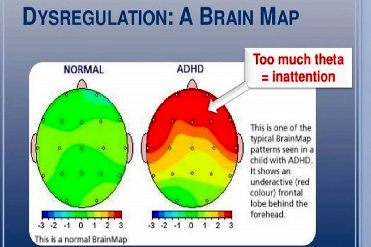 روش های تشخیص اختلال نارسایی توجه-بیش فعالی ADHD
