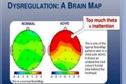 روش های تشخیص اختلال نارسایی توجه-بیش فعالی ADHD
