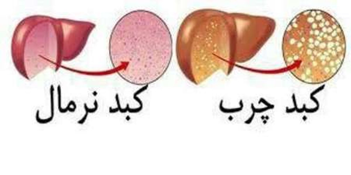 کبد چرب این دسته از نوزادان را تهدید می کند