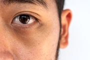 عواملی که باعث تیرگی دور چشم می‌شوند

