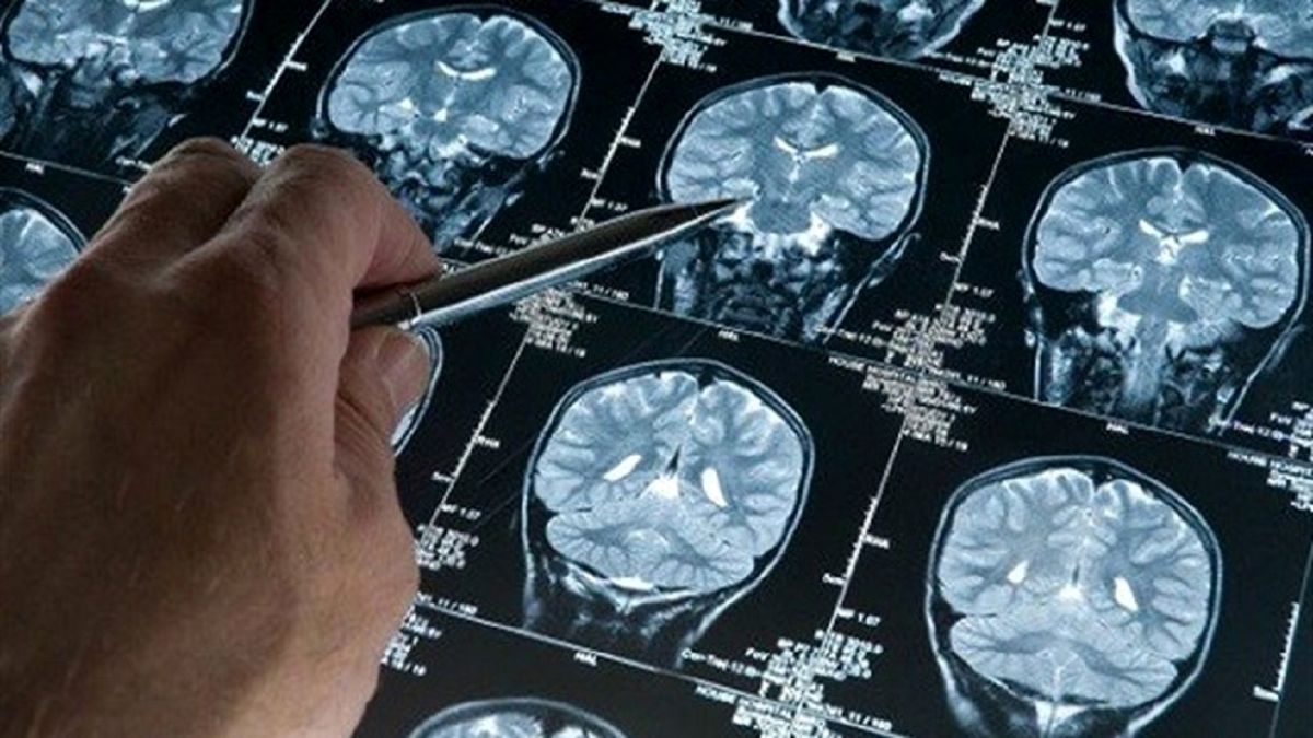 کدام عوامل می‌تواند بروز سکته مغزی را در افراد کاهش دهد؟
