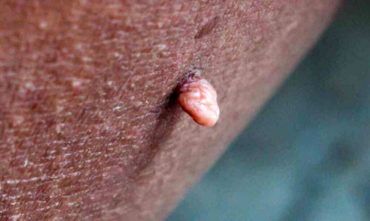 خال های گوشتی در بدن نشانه چیست؟