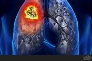 ریه بیماران مبتلا به کرونا پس از بهبودی از بین می‌رود؟

