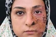 هراس از جذام| ۹۵ درصد جامعه مصونیت ذاتی به جذام دارند
