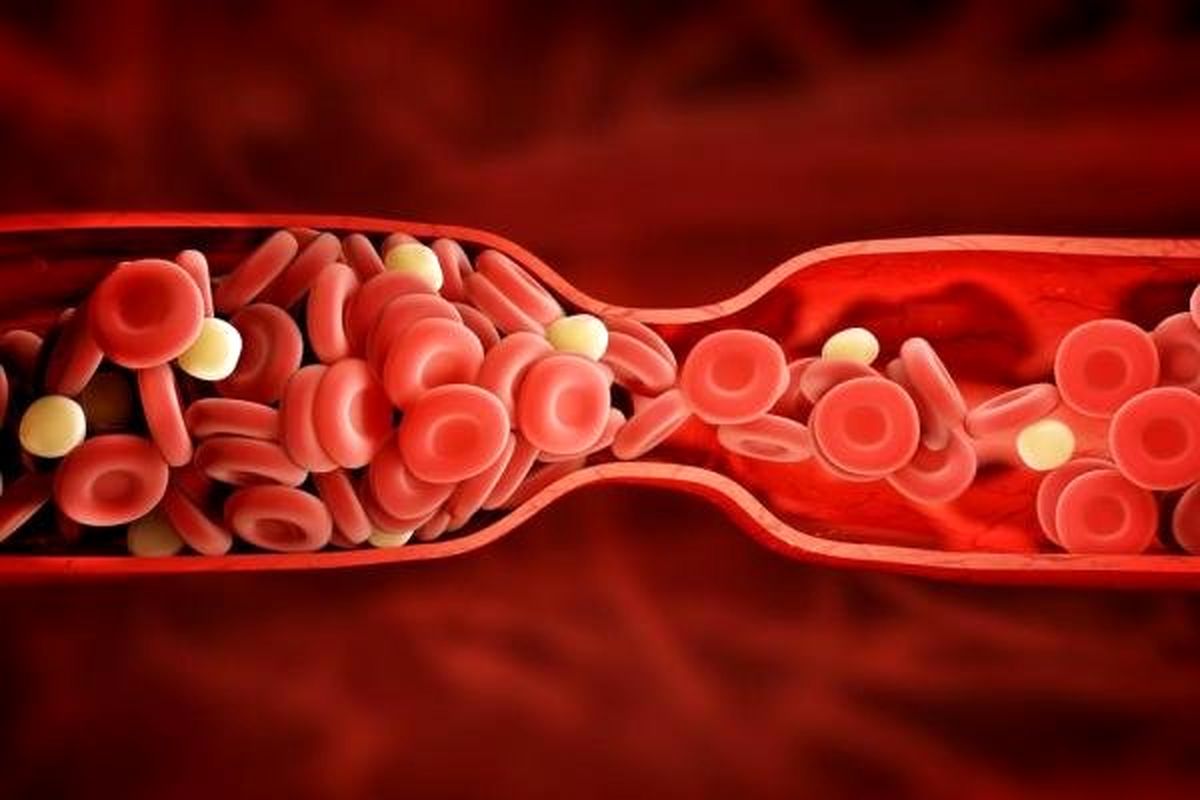 مراقب باشید؛ واریس پا خطرناک است