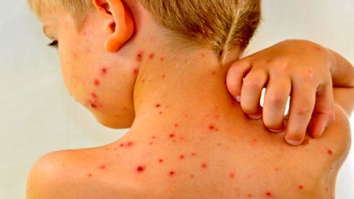 واکسیناسیون تمام کودکان زیر ۵ سال برای مقابله با سرخک ضرورت ندارد
