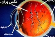 این علائم نشان دهنده بیماری چشم است
