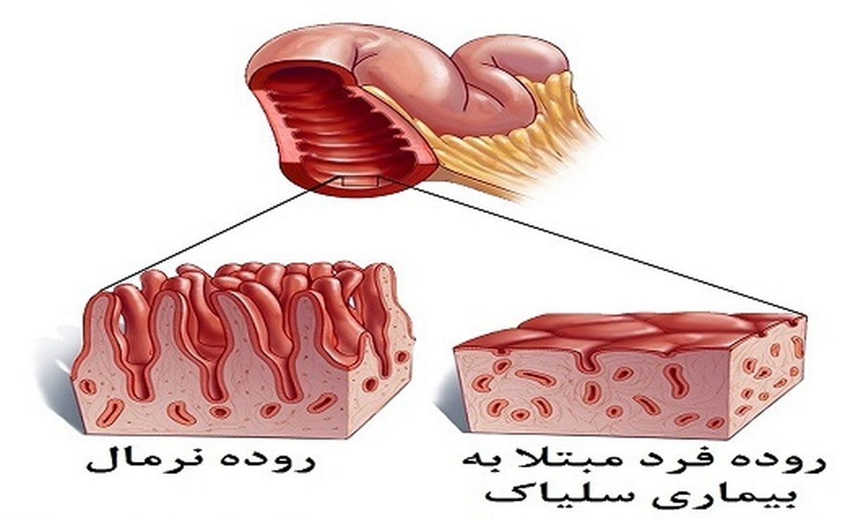 سلیاک، بیماری شایع اما ناشناخته
