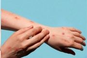 شناسایی علائم جدید آبله میمون
