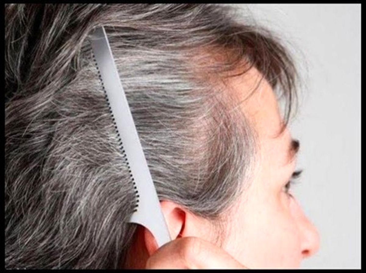 آیا موی کاشته شده سفید می‌شود؟