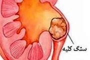 باورهای غلط درباره سنگ کلیه