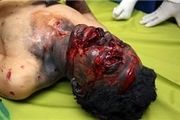 سوختگی جان 18 نفر را در پایخت گرفت
