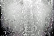 ده‌ها کِرم در شکم مردی که سوشی خورده بود