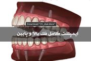 ایمپلنت کامل فک بالا و فک پایین