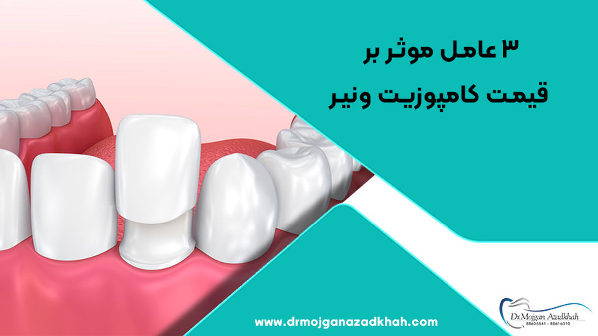 3 عامل موثر بر قیمت کامپوزیت ونیر

