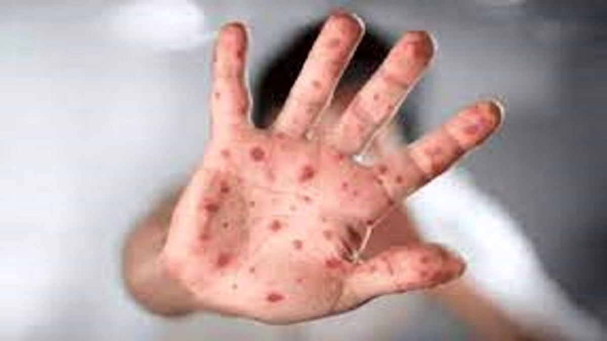 افراد دارای سیستم ایمنی ضعیف در معرض ابتلا به آبله میمونی
