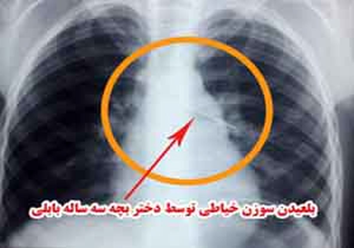 
سوزن خیاطی در نای دختر بچه بابلی
