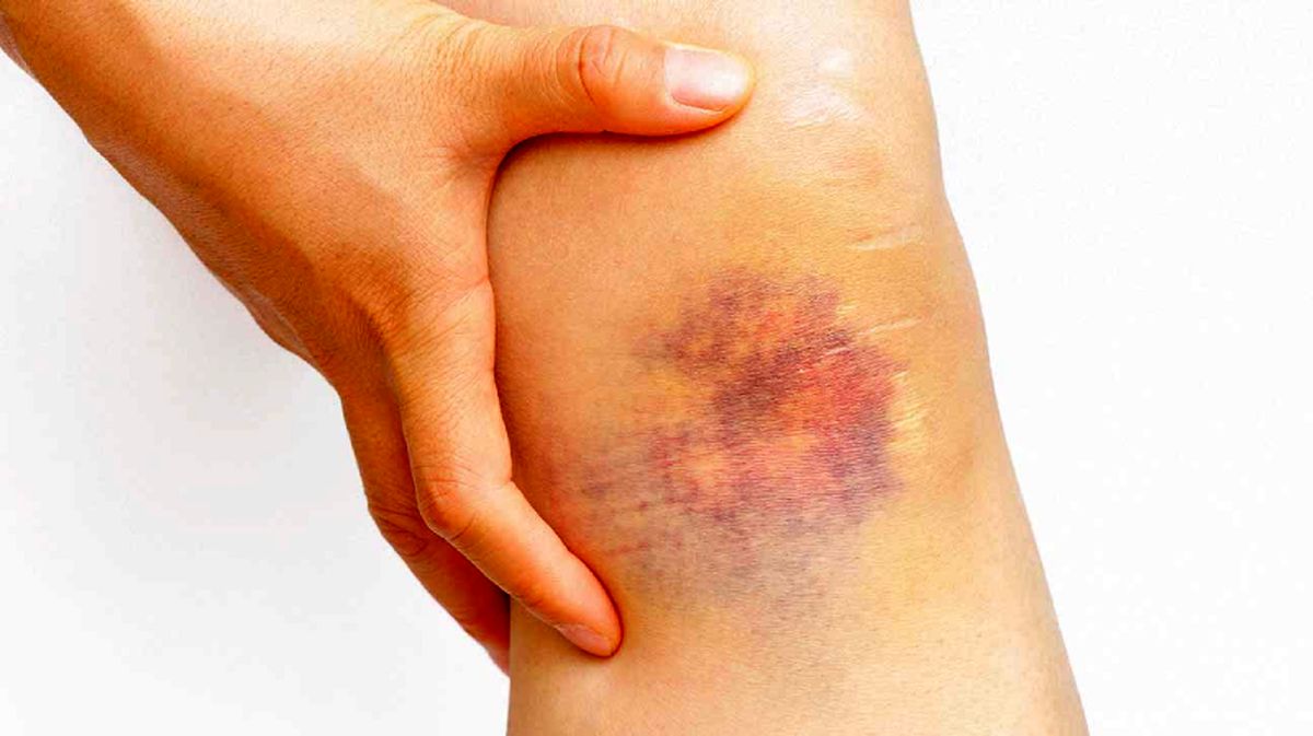 علل کبودی ناگهانی بی دلیل برروی بدن چیست؟
