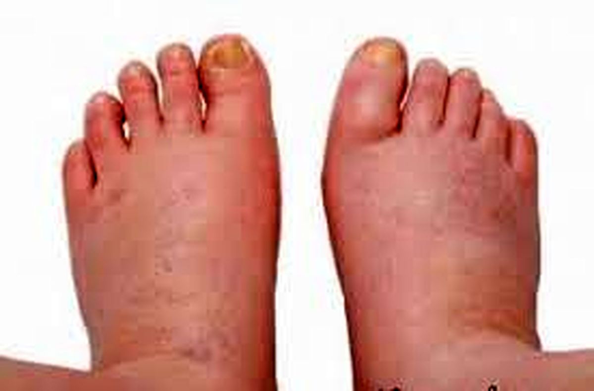 علت تجمع آب در بدن و تورم چیست؟