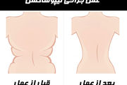 آنچه باید درباره «لیپوساکشن» بدانید
