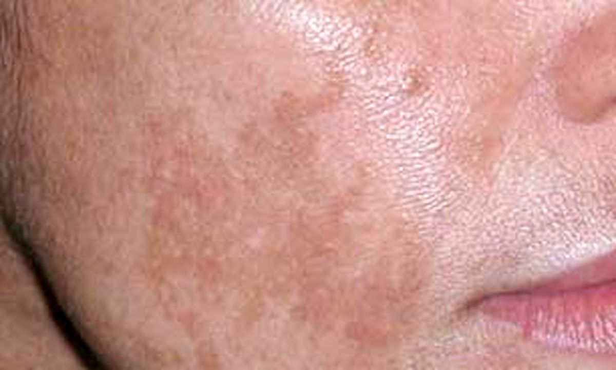 راه‌های خلاصی از کک و مک 