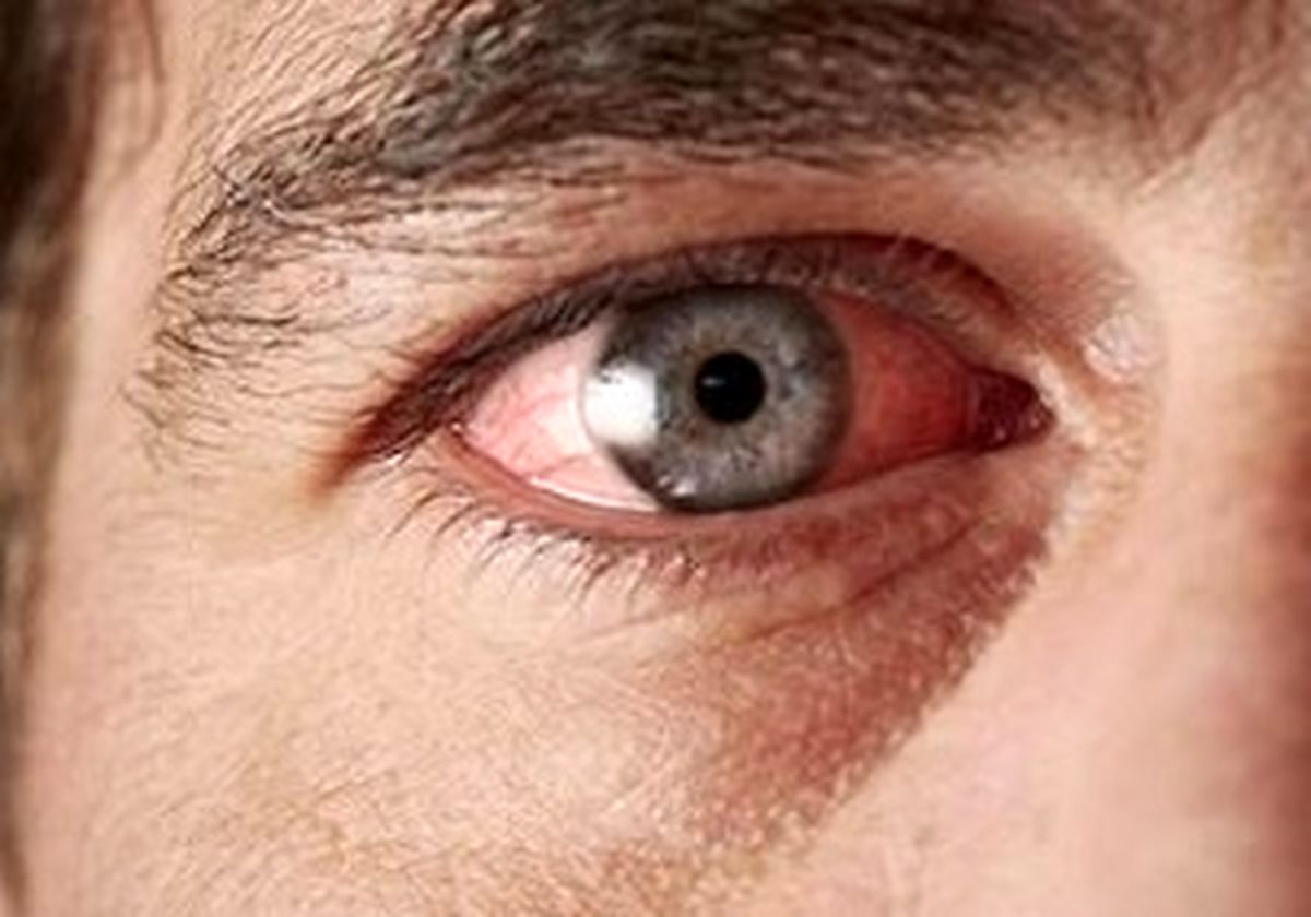 راهکارهایی برای کاهش یا رفع حلقه سیاه زیر چشم